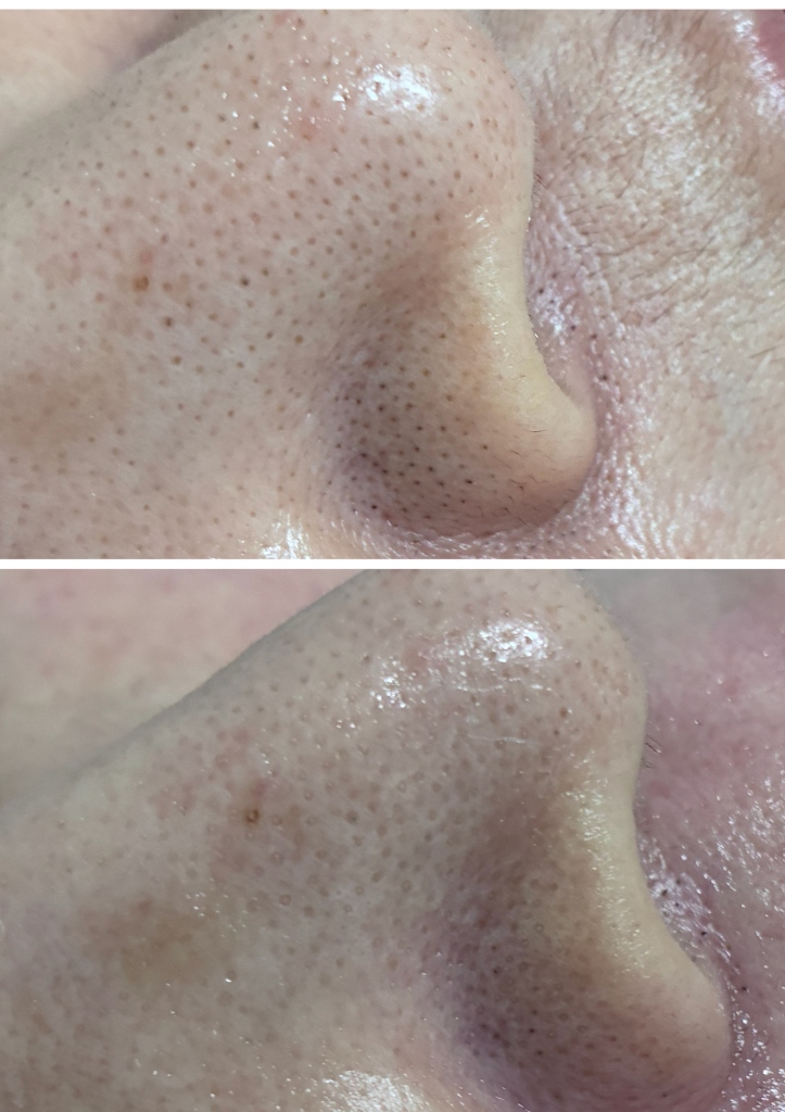 顔WAX 症例写真 2